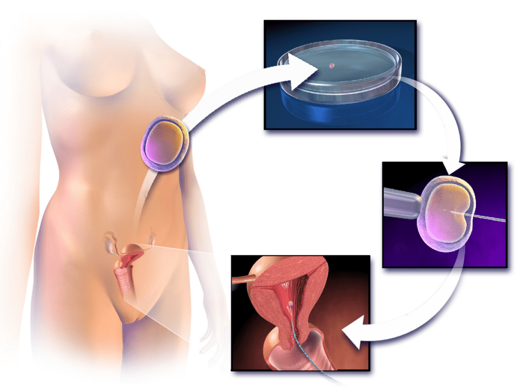 人工受孕的過程示意圖，圖片來源：Wikimedia。